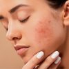Beda Dengan Jerawat Ketahui Semua Hal Tentang Rosacea Disini