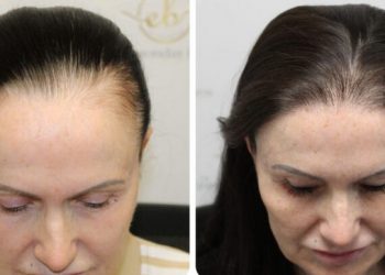 Transplantasi Rambut untuk Perempuan Semakin Marak, Namun Tingkat Keberhasilannya Rumit