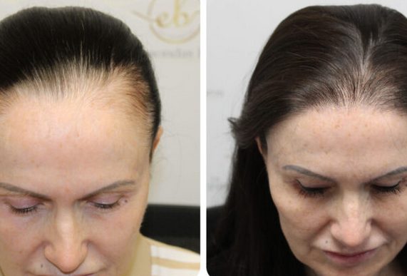 Transplantasi Rambut untuk Perempuan Semakin Marak, Namun Tingkat Keberhasilannya Rumit