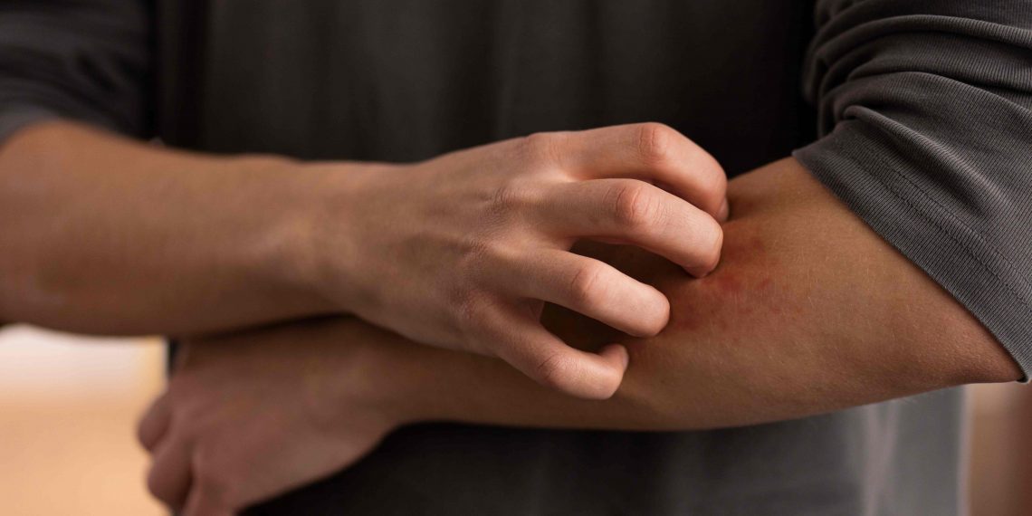 Pasca Banjir, Risiko Penyakit Meningkat dan Tak Bisa Dianggap Sepele