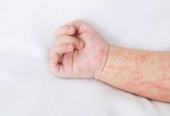 Wabah Campak di Bangladesh, 38 Anak Meninggal Akibat Rendahnya Vaksinasi