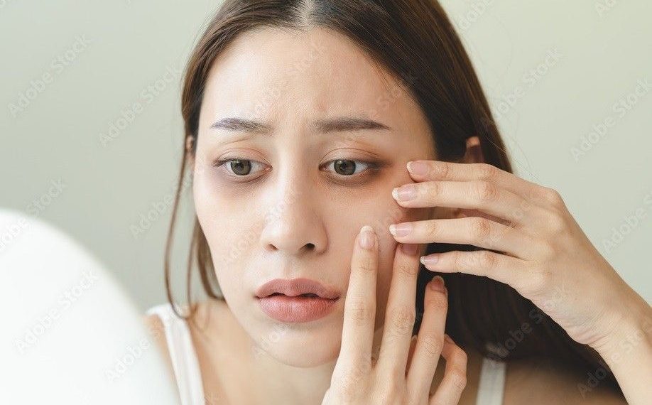 Tips Menghilangkan Mata Panda Tanpa Harus Bergantung pada Eye Cream