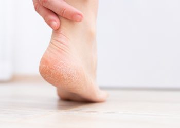 Mulai Sekarang, Jangan Pernah Abaikan Tumit Pecah-pecah! Ini Penyebabnya