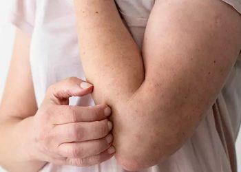 Alergi Bisa Sembuh Total atau Tidak? Begini Penjelasan Medisnya