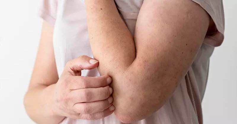 Alergi Bisa Sembuh Total atau Tidak? Begini Penjelasan Medisnya