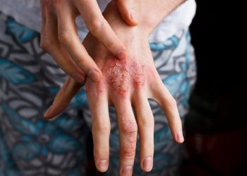 Eksim dapat membuat kulit kering, merah, bersisik, dan gatal. Kenali penyebab, pemicu, cara meredakan gejala, serta tanda eksim perlu diperiksa.