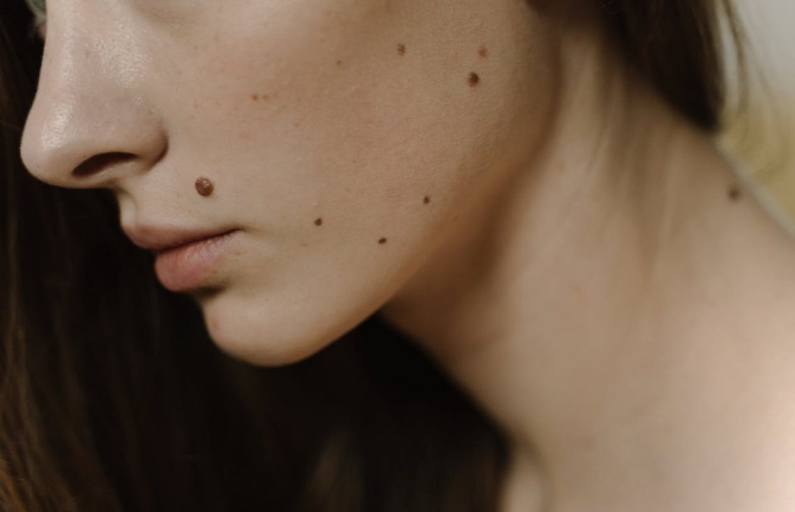Astrology Beliefs Highlight 6 Lucky Mole Spots Associated With Success