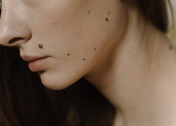 Astrology Beliefs Highlight 6 Lucky Mole Spots Associated With Success