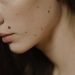 Astrology Beliefs Highlight 6 Lucky Mole Spots Associated With Success