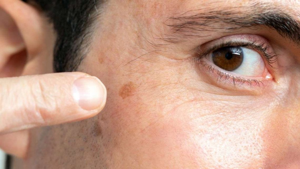 Why Dark Spots Appear on Your Face and How to Prevent Them