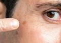 Why Dark Spots Appear on Your Face and How to Prevent Them