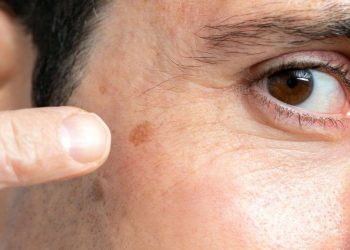 Why Dark Spots Appear on Your Face and How to Prevent Them