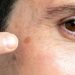 Why Dark Spots Appear on Your Face and How to Prevent Them