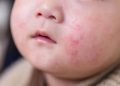 Cow’s Milk Allergy Symptoms in Children Can Vary, Experts Warn