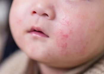 Cow’s Milk Allergy Symptoms in Children Can Vary, Experts Warn