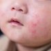 Cow’s Milk Allergy Symptoms in Children Can Vary, Experts Warn