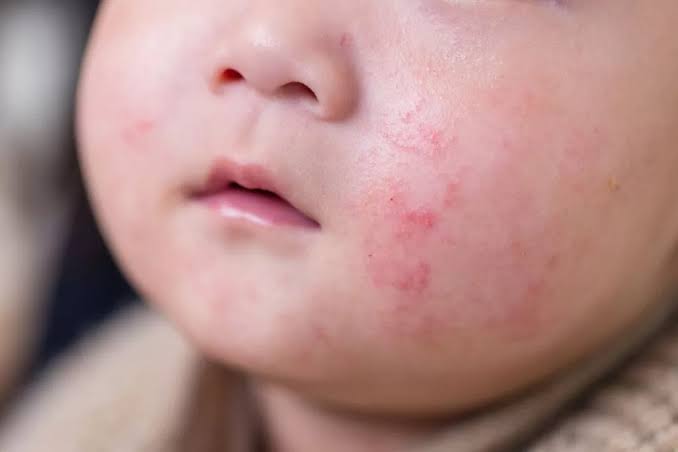 Cow’s Milk Allergy Symptoms in Children Can Vary, Experts Warn