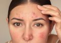 5 Signs of Chronic Stress That Can Show Up on Your Skin