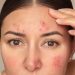 5 Signs of Chronic Stress That Can Show Up on Your Skin