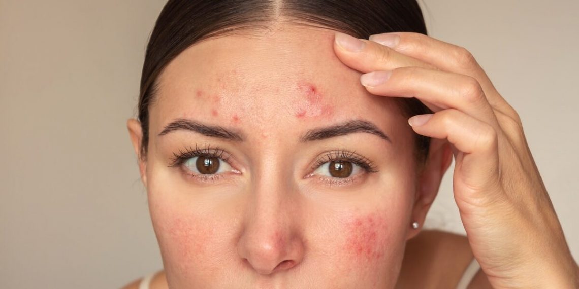 5 Signs of Chronic Stress That Can Show Up on Your Skin