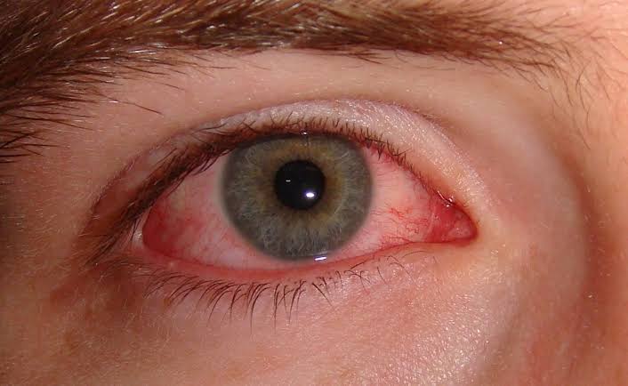 Anak Krakatau Ash Reaches Jakarta, Here Are 6 Ways to Protect Your Eyes