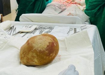 Sri Lanka Doctors Remove 3.1-Kilogram Bladder Stone From 55-Year-Old Man