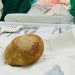Sri Lanka Doctors Remove 3.1-Kilogram Bladder Stone From 55-Year-Old Man