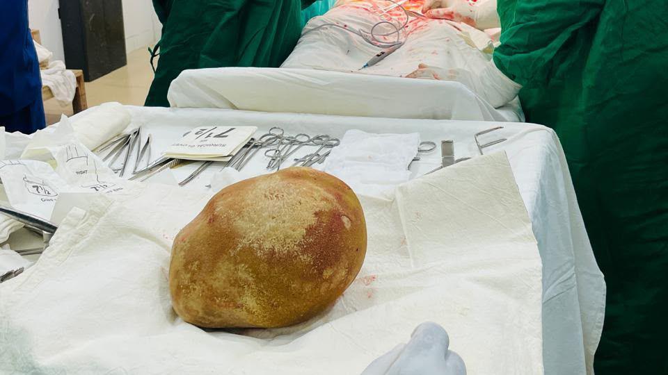 Sri Lanka Doctors Remove 3.1-Kilogram Bladder Stone From 55-Year-Old Man