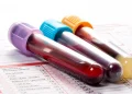 This Blood Type May Have a Higher Risk of Type 2 Diabetes, Study Finds