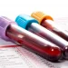 This Blood Type May Have a Higher Risk of Type 2 Diabetes, Study Finds