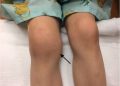 Swollen Knee in 18-Month-Old Girl Leads to Juvenile Arthritis Diagnosis