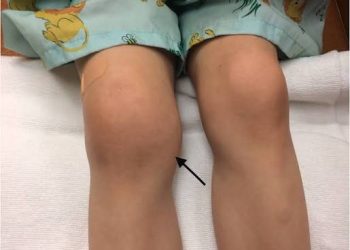 Swollen Knee in 18-Month-Old Girl Leads to Juvenile Arthritis Diagnosis