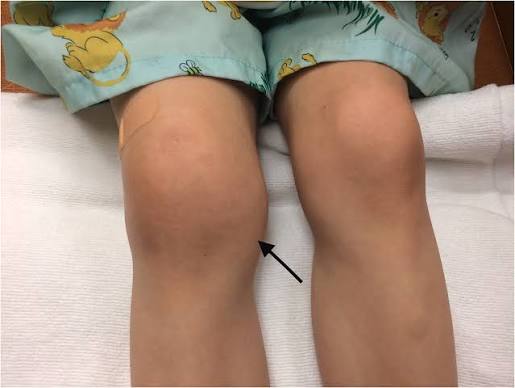 Swollen Knee in 18-Month-Old Girl Leads to Juvenile Arthritis Diagnosis