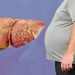 Sugary Drinks May Raise Fatty Liver Risk, Doctors Warn