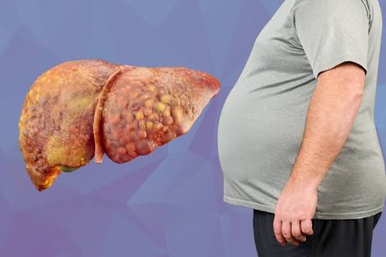 Sugary Drinks May Raise Fatty Liver Risk, Doctors Warn