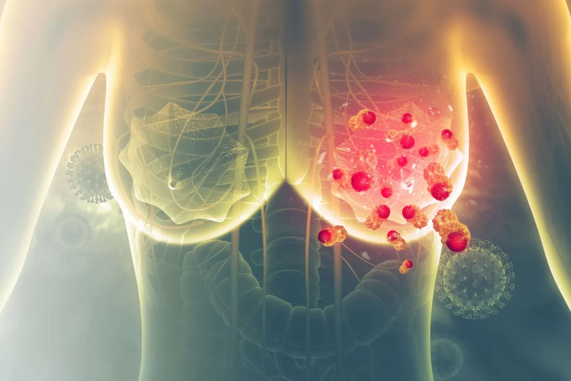 Breast Cancer Can Develop Without Family History, Doctor Warns