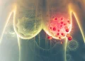 Breast Cancer Can Develop Without Family History, Doctor Warns