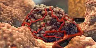 Perjalanan Menuju Kesembuhan dari Penyakit Tumor