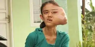 Bentuk Wajah tidak lagi sama