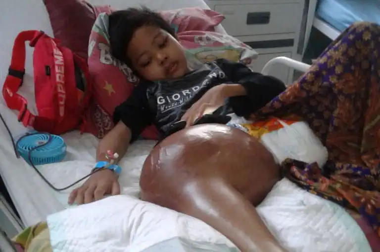 Tumor di Kaki Dan Membesar