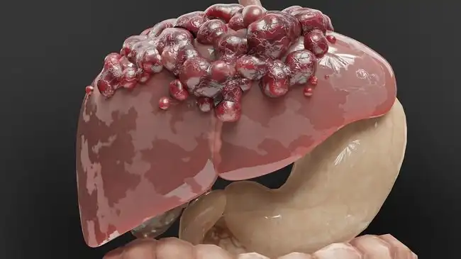 Kok Bisa Sih Kita Kena Tumor Ganas? Jangan-jangan Kebiasaan Kita Sendiri Biang Keroknya!