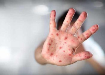 Wabah Campak di Bangladesh Tewaskan 38 Anak, Pemerintah Percepat Imunisasi