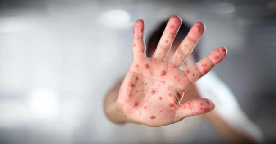 Wabah Campak di Bangladesh Tewaskan 38 Anak, Pemerintah Percepat Imunisasi