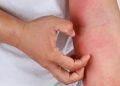 Mengapa Alergi Tak Selalu Hilang? Ini Penjelasan Medis Lengkapnya
