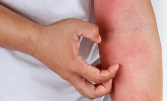 Mengapa Alergi Tak Selalu Hilang? Ini Penjelasan Medis Lengkapnya