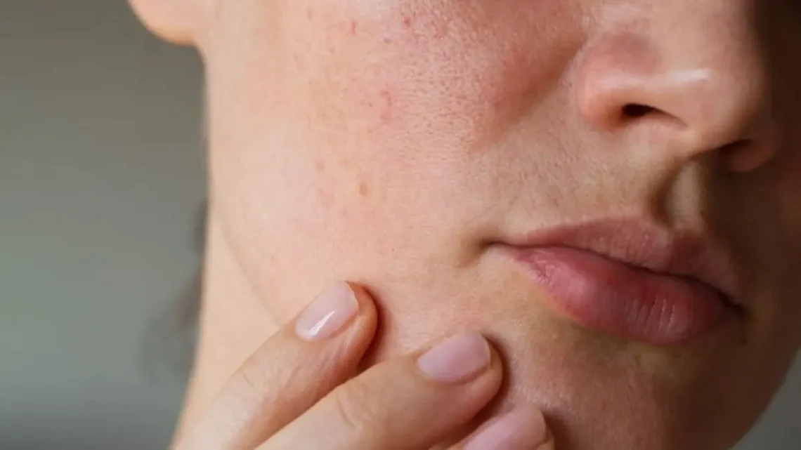 Eksim Sering Kambuh? Dermatolog Ungkap Tips Merawat Kulit