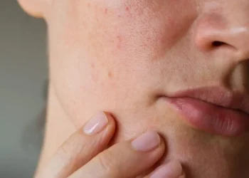 Eksim Sering Kambuh? Dermatolog Ungkap Tips Merawat Kulit