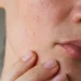 Eksim Sering Kambuh? Dermatolog Ungkap Tips Merawat Kulit