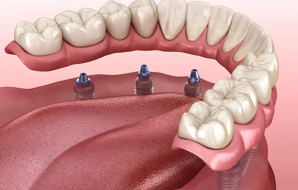 Gusi Menyusut Bisa Balik Lagi? Mengenal Gingival Graft, Rahasia Cangkok Gusi
