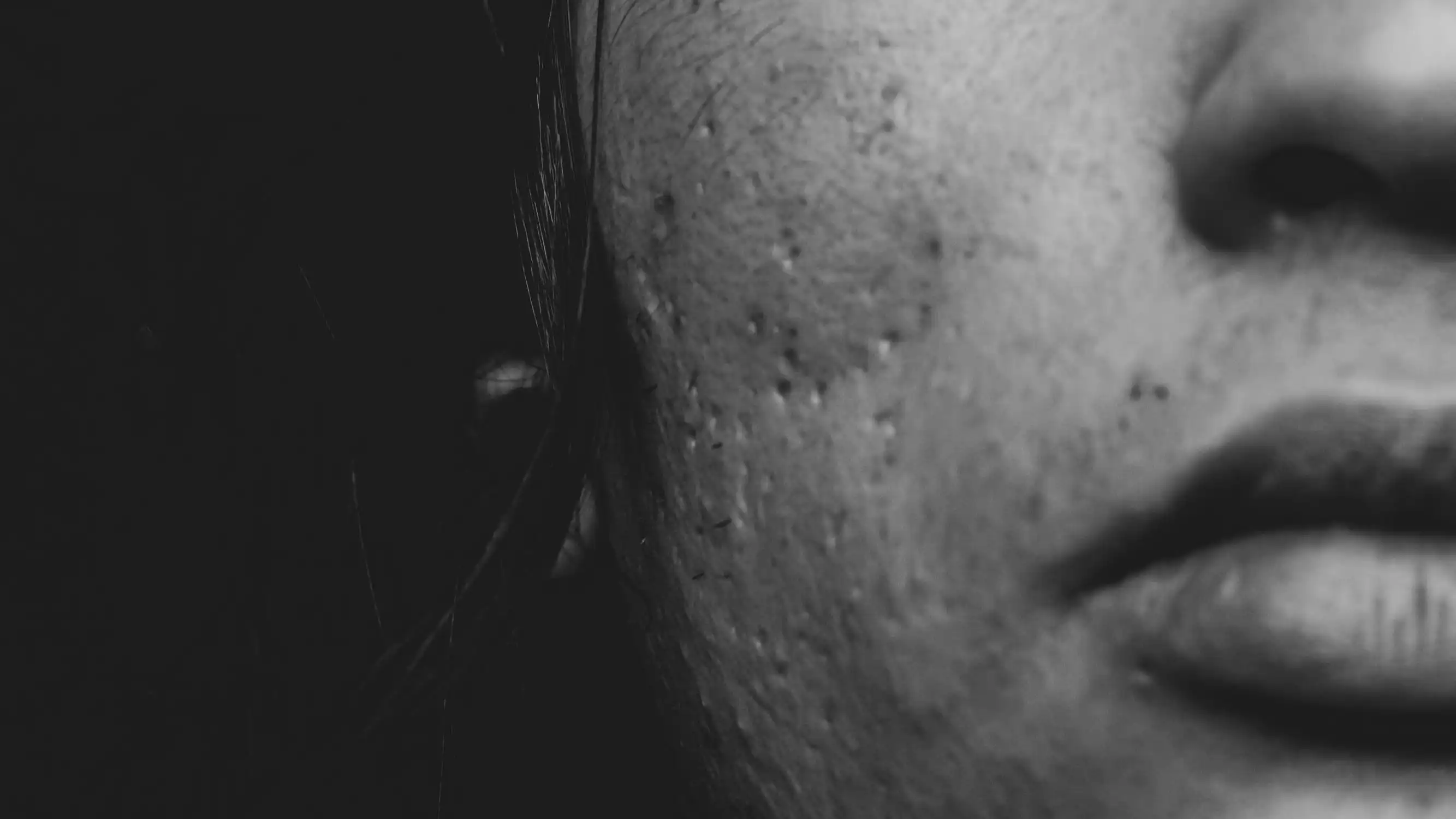 Mengenal Jenis Bopeng Bekas Jerawat dan Cara Mengatasinya